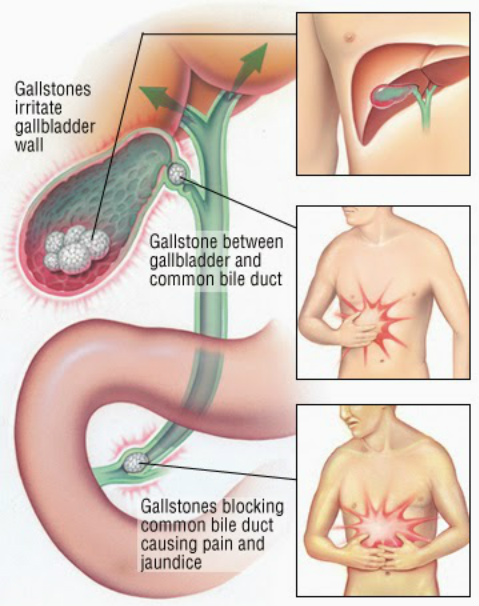 How do you get rid of gall stones?